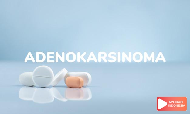 arti adenokarsinoma adalah <p>Adenokarsinoma adalah kanker yang dimulai di sel yang melapisi organ-organ internal tertentu dan yang memiliki properti mirip kelenjar.</p> dalam kamus kesehatan bahasa indonesia online by Aplikasi Indonesia